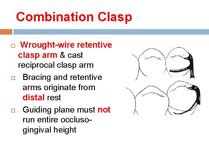 Combination Clasp Wrought-wire retentive clasp arm & cast reciprocal clasp arm Bracing and retentive