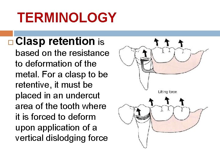 TERMINOLOGY Clasp retention is based on the resistance to deformation of the metal. For