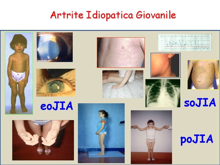 Artrite Idiopatica Giovanile Poliarticolare Oligoaarticolare Frequenza 30% 60% Articolazioni (n°) Età all’esordio >5 tutte