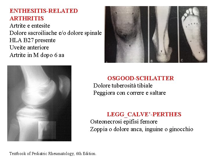 ENTHESITIS-RELATED ARTHRITIS Artrite e entesite Dolore sacroiliache e/o dolore spinale HLA B 27 presente