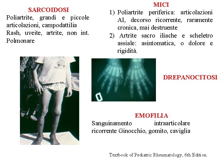 SARCOIDOSI Poliartrite, grandi e piccole articolazioni, campodattilia Rash, uveite, artrite, non int. Polmonare MICI