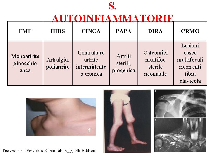 S. AUTOINFIAMMATORIE FMF Monoartrite ginocchio anca HIDS Artralgia, poliartrite CINCA Contratture artrite intermittente o