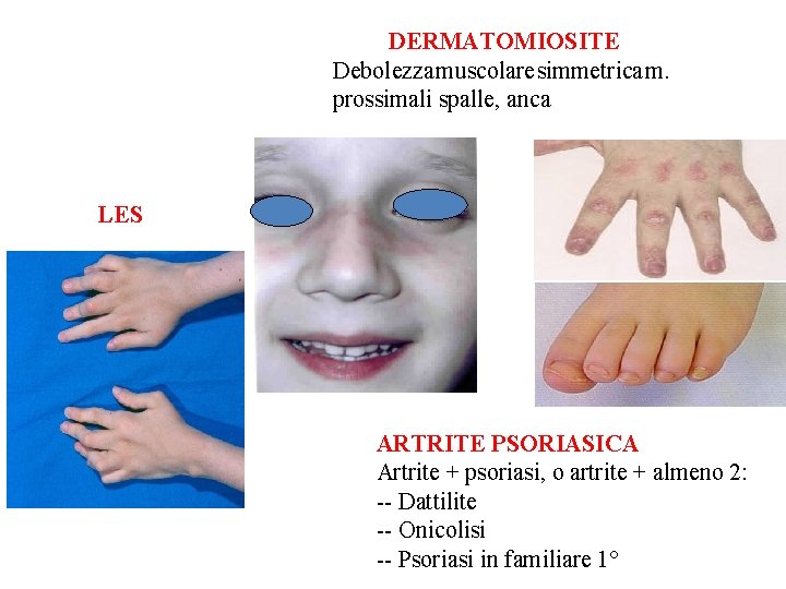 DERMATOMIOSITE Debolezza muscolare simmetrica m. prossimali spalle, anca LES ARTRITE PSORIASICA Artrite + psoriasi,