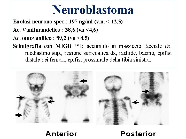 Neuroblastoma Enolasi neurono spec. : 197 ng/ml (v. n. < 12, 5) Ac. Vanilmandelico