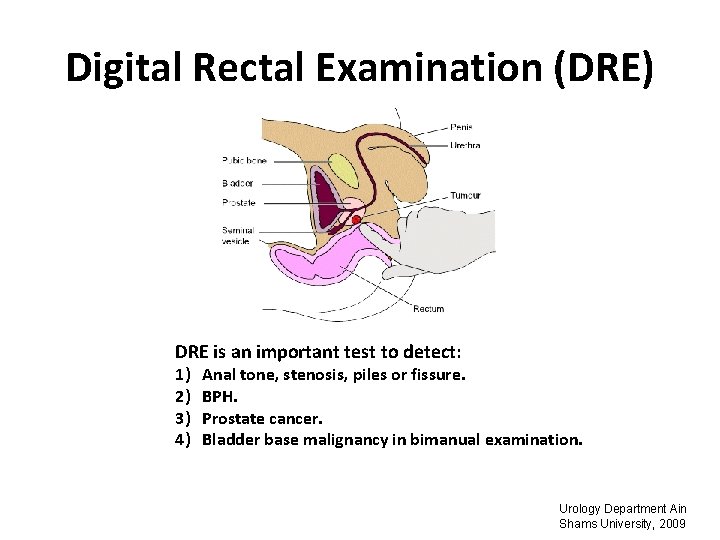 Digital Rectal Examination (DRE) DRE is an important test to detect: 1) 2) 3)