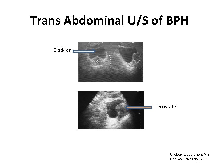 Trans Abdominal U/S of BPH Bladder Prostate Urology Department Ain Shams University, 2009 
