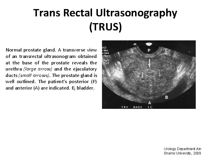 Trans Rectal Ultrasonography (TRUS) Normal prostate gland. A transverse view of an transrectal ultrasonogram