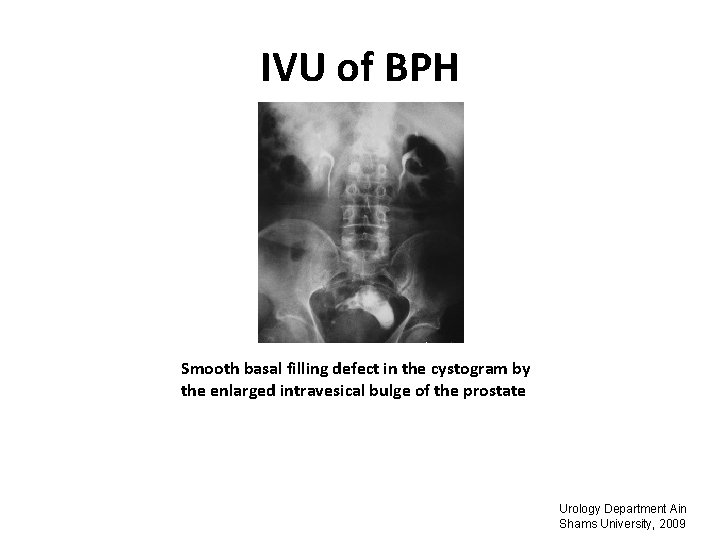 IVU of BPH Smooth basal filling defect in the cystogram by the enlarged intravesical