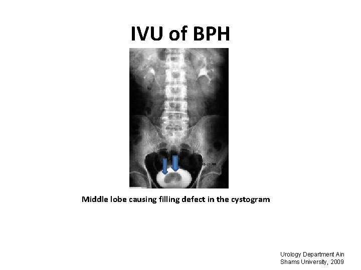 IVU of BPH Middle lobe causing filling defect in the cystogram Urology Department Ain