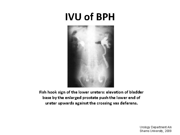 IVU of BPH Fish hook sign of the lower ureters: elevation of bladder base