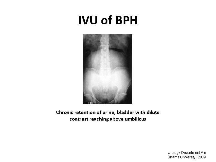 IVU of BPH Chronic retention of urine, bladder with dilute contrast reaching above umbilicus