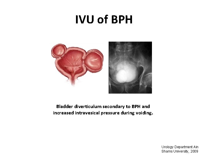 IVU of BPH Bladder diverticulum secondary to BPH and increased intravesical pressure during voiding.