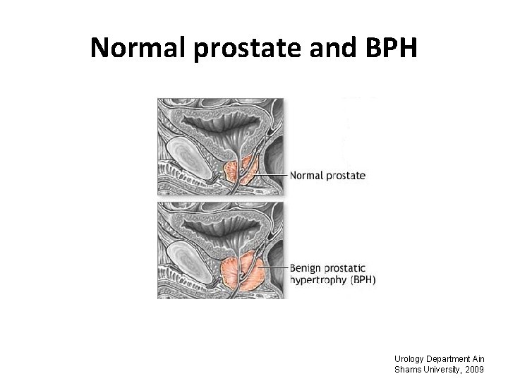 Normal prostate and BPH Urology Department Ain Shams University, 2009 