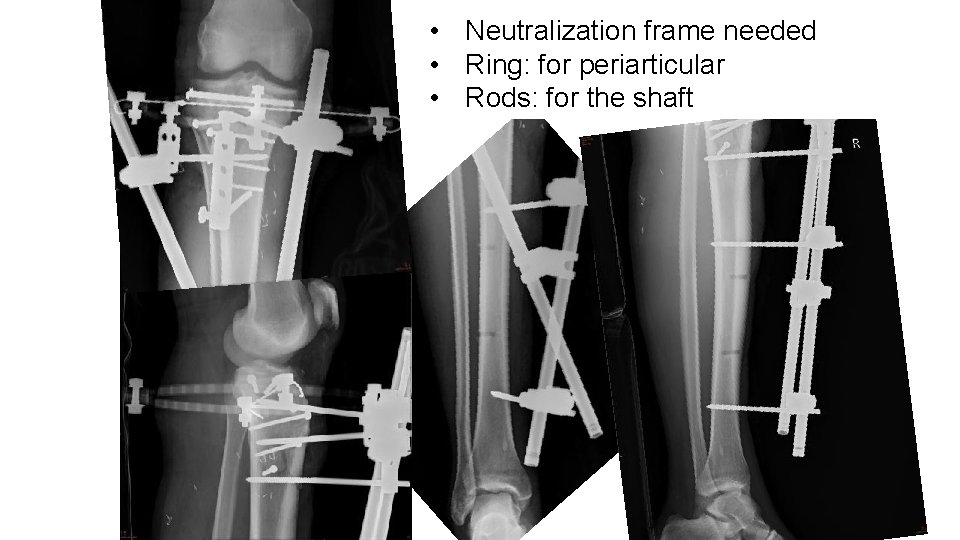  • Neutralization frame needed • Ring: for periarticular • Rods: for the shaft