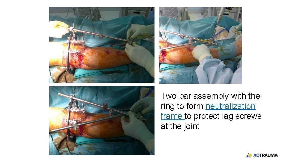 Two bar assembly with the ring to form neutralization frame to protect lag screws