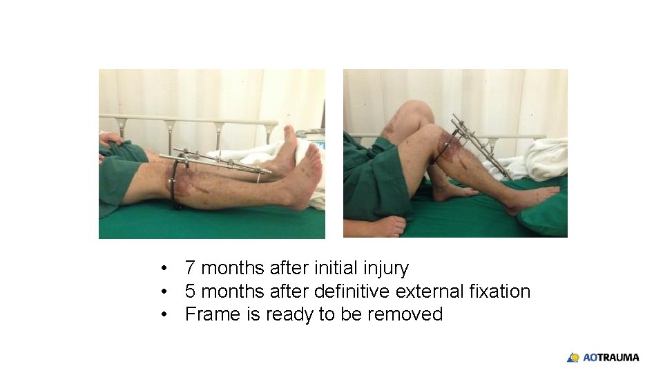  • 7 months after initial injury • 5 months after definitive external fixation