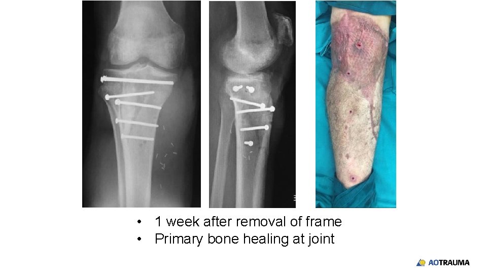  • 1 week after removal of frame • Primary bone healing at joint