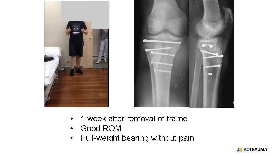  • 1 week after removal of frame • Good ROM • Full-weight bearing