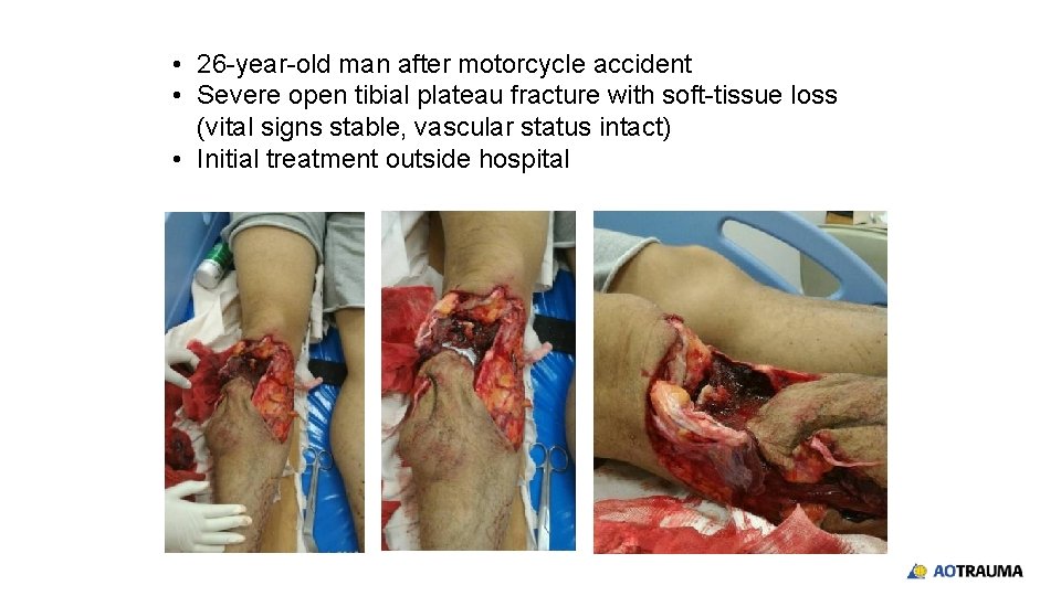  • 26 -year-old man after motorcycle accident • Severe open tibial plateau fracture