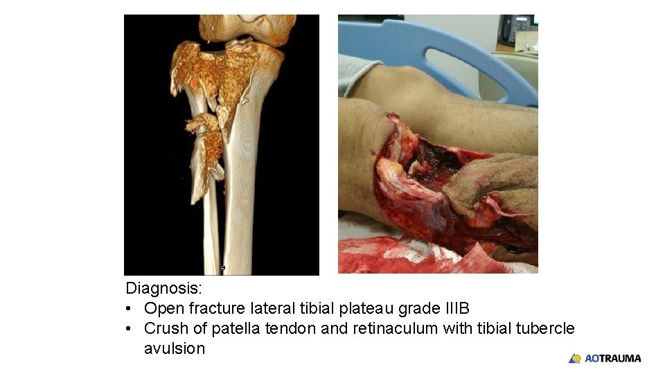 Diagnosis: • Open fracture lateral tibial plateau grade IIIB • Crush of patella tendon