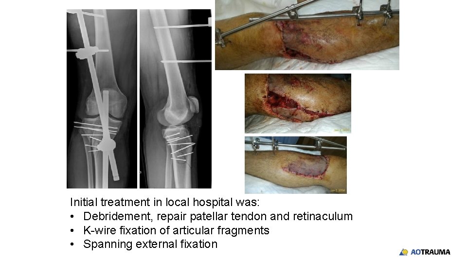 Initial treatment in local hospital was: • Debridement, repair patellar tendon and retinaculum •