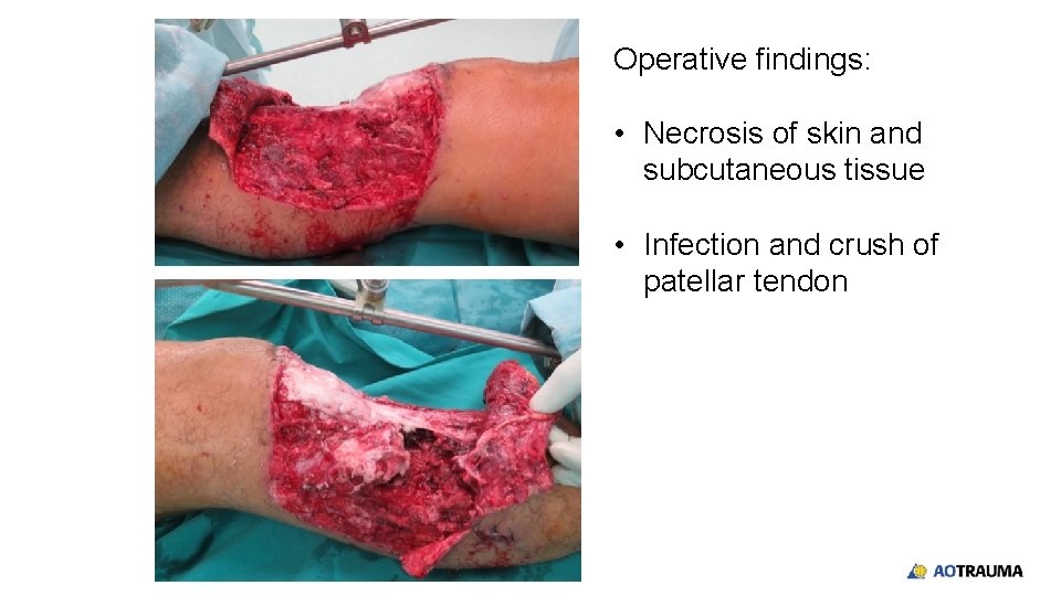 Operative findings: • Necrosis of skin and subcutaneous tissue • Infection and crush of
