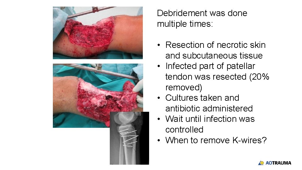 Debridement was done multiple times: • Resection of necrotic skin and subcutaneous tissue •