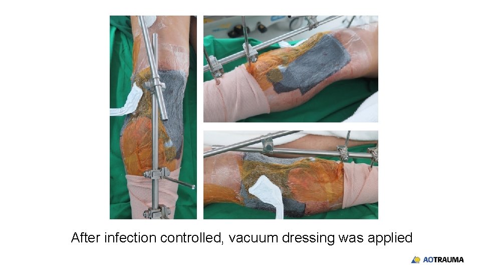 After infection controlled, vacuum dressing was applied 