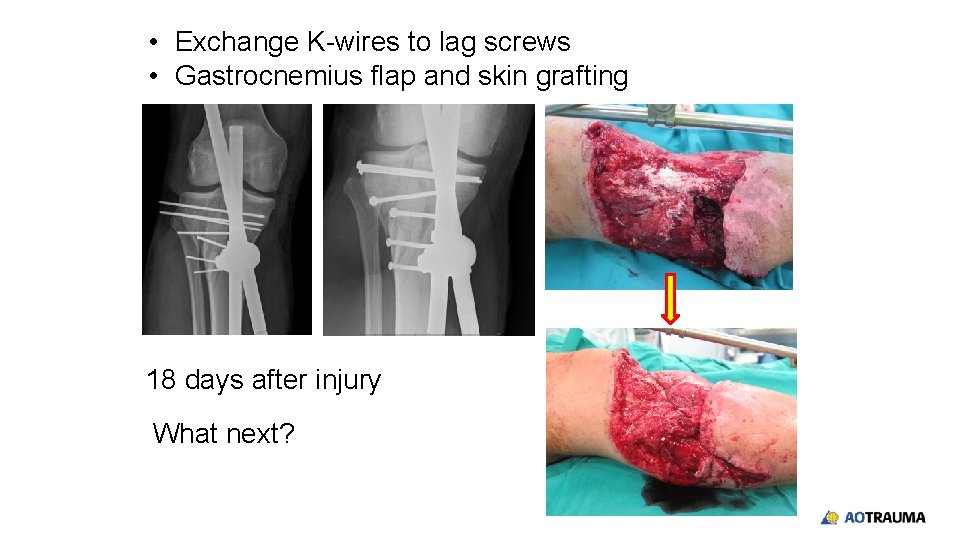  • Exchange K-wires to lag screws • Gastrocnemius flap and skin grafting 18