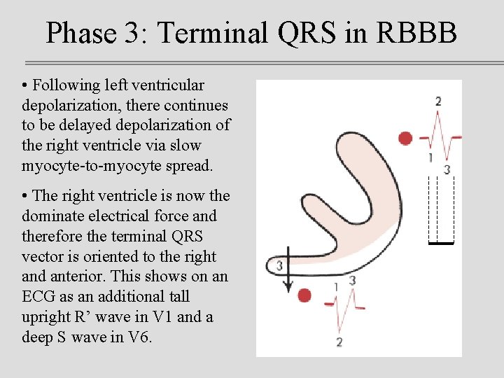 Phase 3: Terminal QRS in RBBB • Following left ventricular depolarization, there continues to