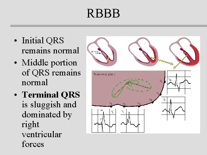 RBBB • Initial QRS remains normal • Middle portion of QRS remains normal •