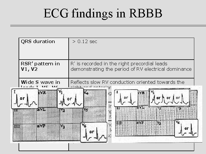 ECG findings in RBBB QRS duration > 0. 12 sec RSR’ pattern in V