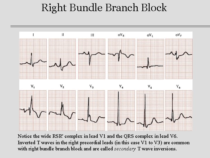 Right Bundle Branch Block Notice the wide RSR' complex in lead V 1 and