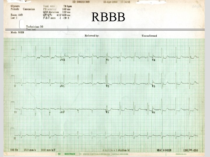 RBBB 