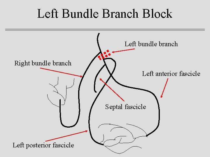 Left Bundle Branch Block Left bundle branch Right bundle branch Left anterior fascicle Septal