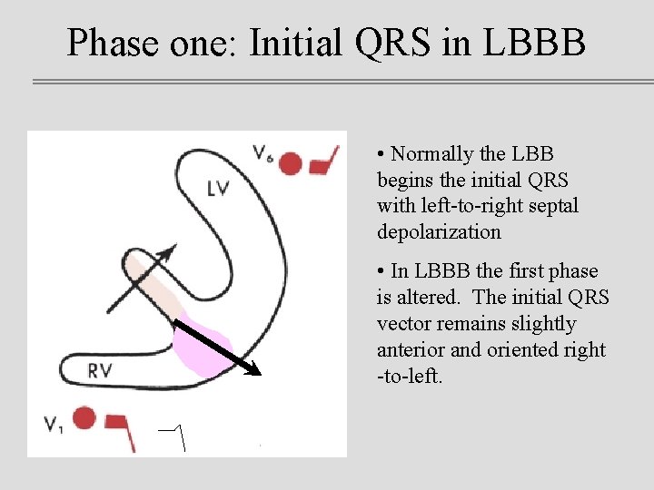 Phase one: Initial QRS in LBBB • Normally the LBB begins the initial QRS