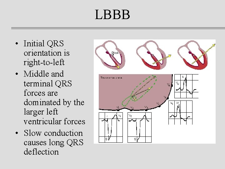 LBBB • Initial QRS orientation is right-to-left • Middle and terminal QRS forces are