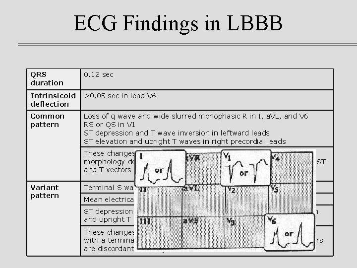 ECG Findings in LBBB QRS duration 0. 12 sec Intrinsicoid deflection >0. 05 sec