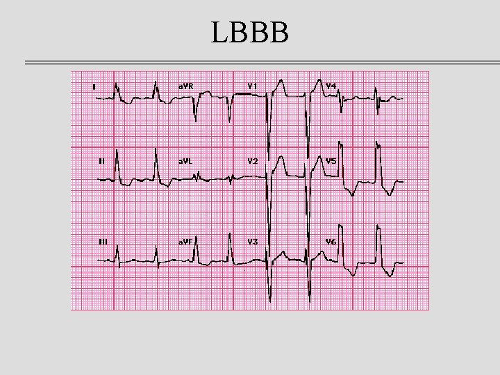 LBBB 