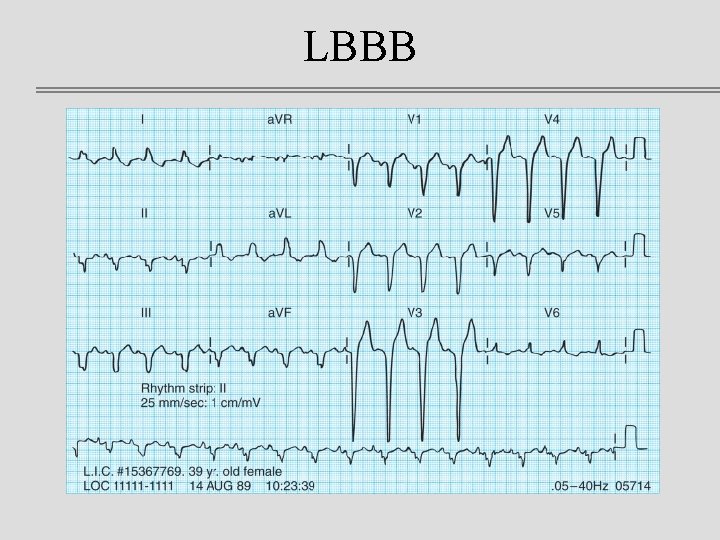 LBBB 