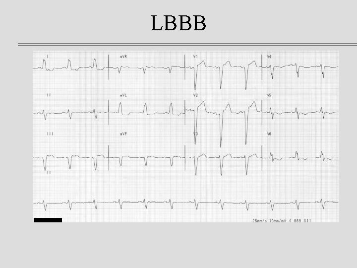 LBBB 