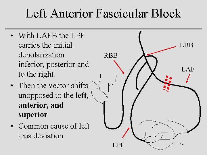 Left Anterior Fascicular Block • With LAFB the LPF carries the initial depolarization inferior,