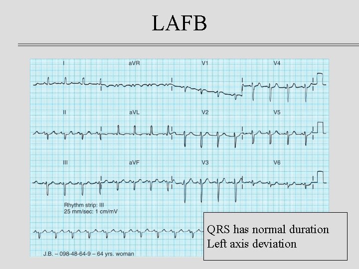 LAFB QRS has normal duration Left axis deviation 