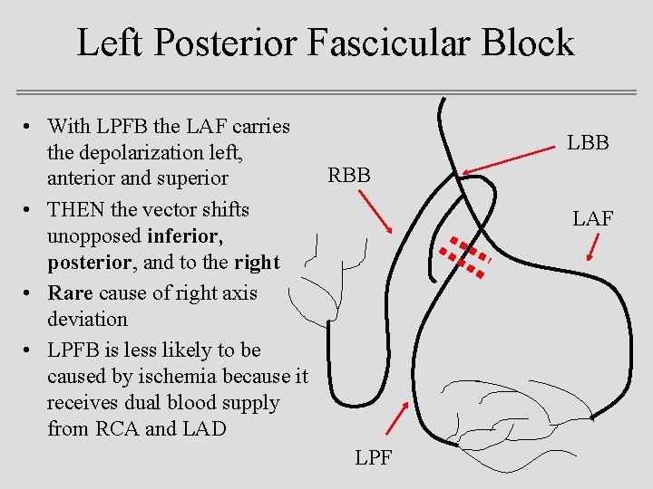 Left Posterior Fascicular Block • With LPFB the LAF carries the depolarization left, RBB