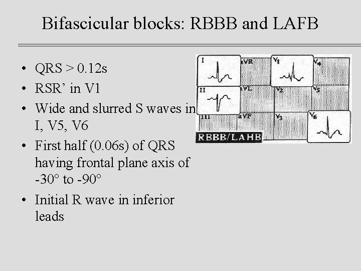 Bifascicular blocks: RBBB and LAFB • QRS > 0. 12 s • RSR’ in