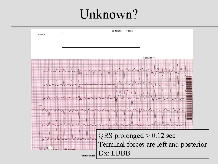 Unknown? QRS prolonged > 0. 12 sec Terminal forces are left and posterior Dx: