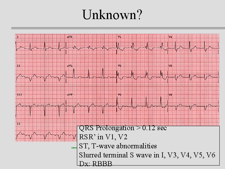 Unknown? QRS Prolongation > 0. 12 sec RSR’ in V 1, V 2 ST,