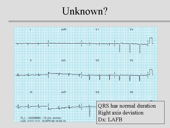 Unknown? QRS has normal duration Right axis deviation Dx: LAFB 