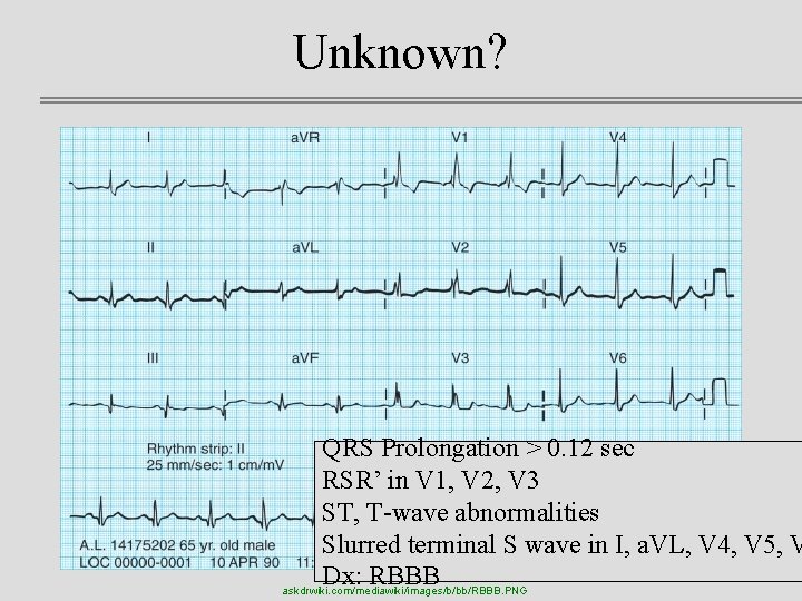 Unknown? QRS Prolongation > 0. 12 sec RSR’ in V 1, V 2, V