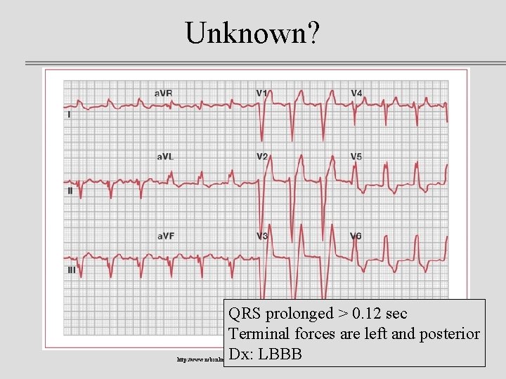 Unknown? QRS prolonged > 0. 12 sec Terminal forces are left and posterior Dx: